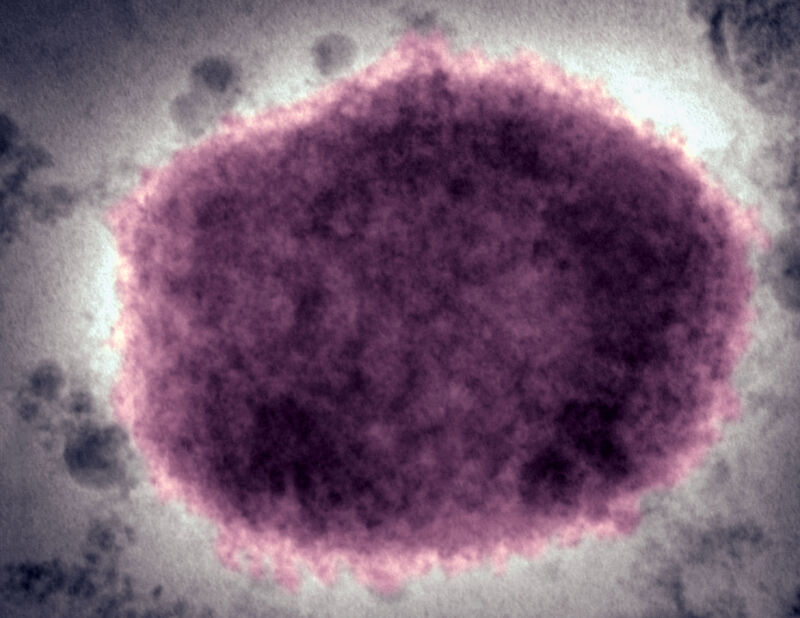 A negative stain electron micrograph of an mpox virus virion in human vesicular fluid.
